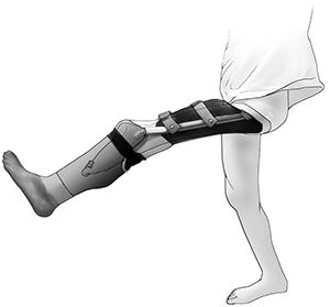 Plastyka rotacyjna - proteza